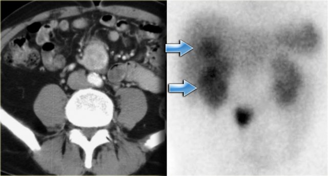 Positive octreoscan in a patient with carcinoid and liver metastases (blue arrows)