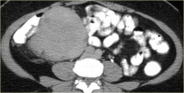 Mesenteric fibromatosis with a fibrous stroma
