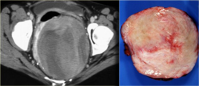 Mesenteric fibromatosis arising in the mesentery of a J-pouch in a patient with familial adenomatous polyposis