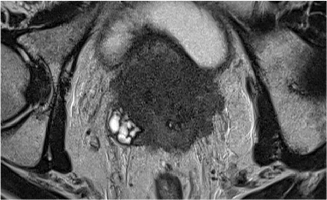 Poorly differentiated adenocarcinoma of the prostate