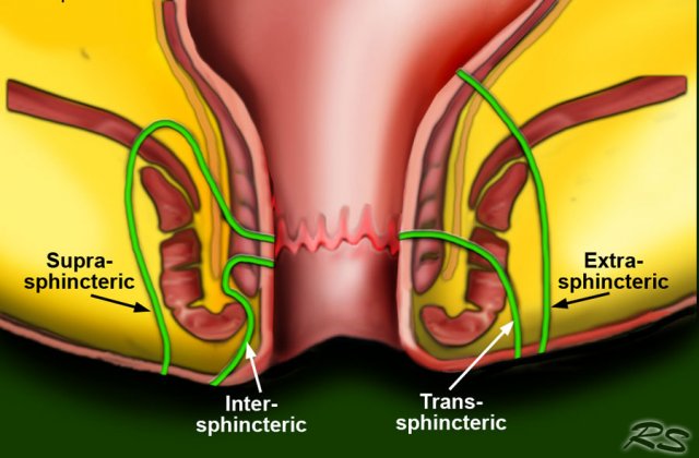 Fistula anal superficial