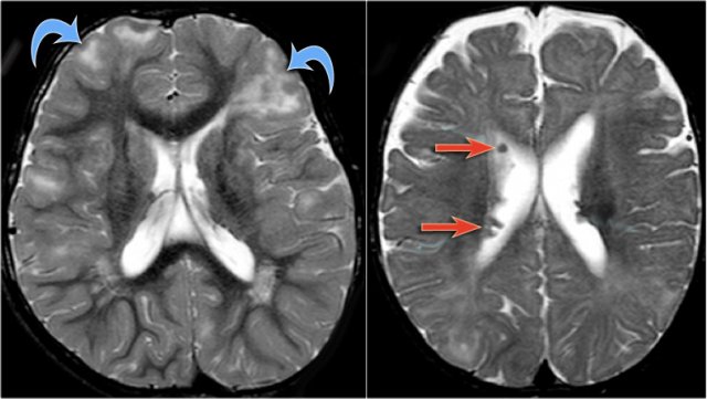 Axial T2w shows multiple tubers and white matter abnormalities (fig. a: arrows) and subependymal nodules