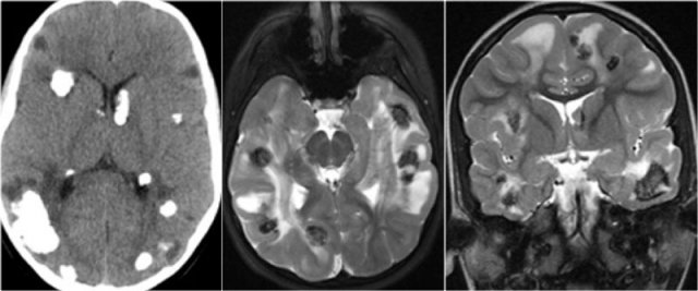 Tuberous Sclerosis - courtesy of the American Journal of Neuroradiology.