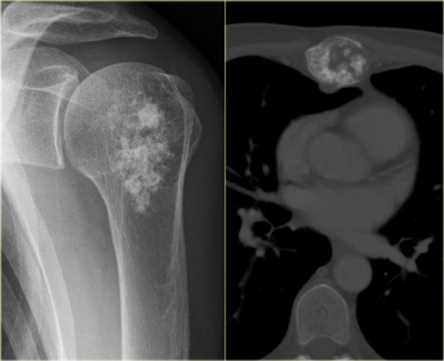 Chondrosarcoma in humeral head and sternum