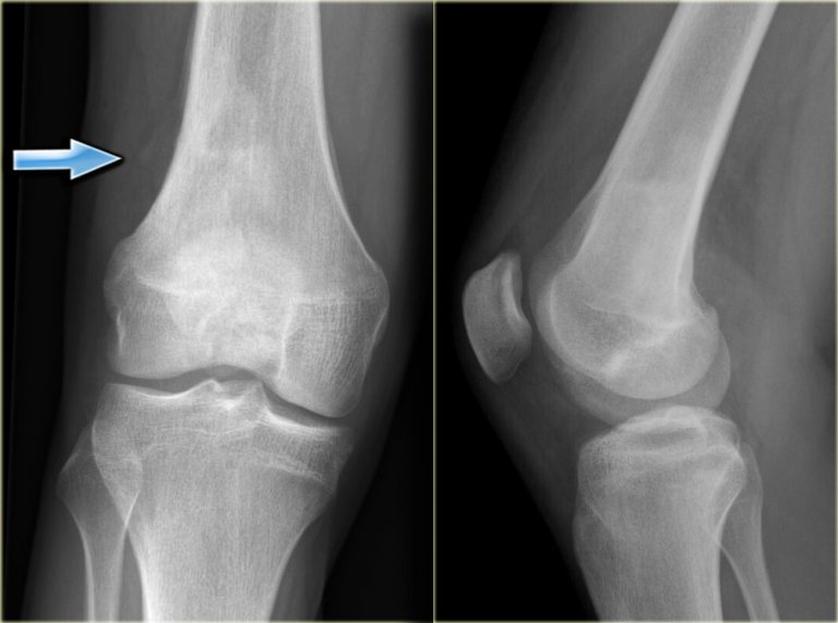 The Radiology Assistant : Sclerotic bone tumors