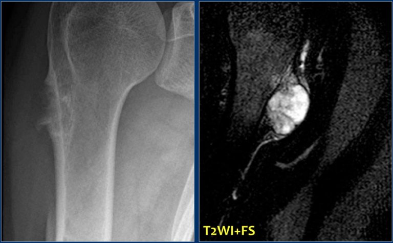 The Radiology Assistant : Sclerotic Bone Tumors