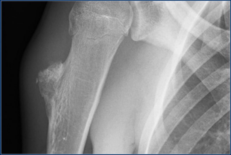 The Radiology Assistant : Sclerotic bone tumors