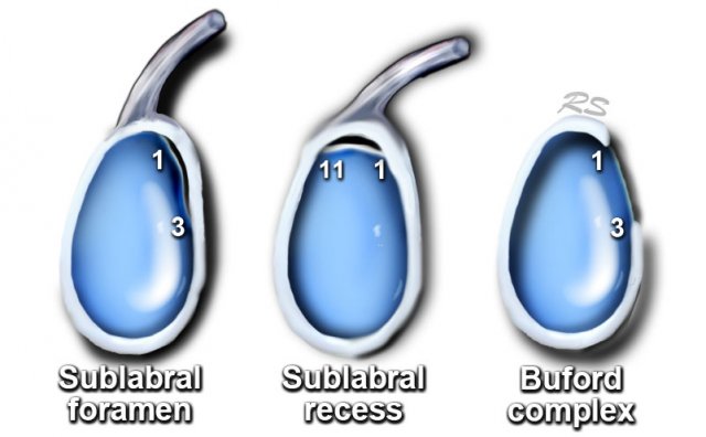 Labral variants and SLAP-tear
