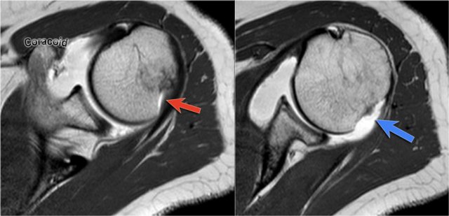 LEFT: Hill-Sachs at level of coracoid. RIGHT: Normal groove seen at level below coracoid.