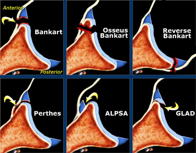 Axial images of Bankart lesions and variants