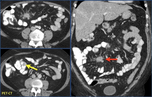 Small intraluminal mass in the ileum (yellow arrow). Associated spiculated mesenteric mass  with adjacent desmoplastic reaction in small bowel carcinoid. 