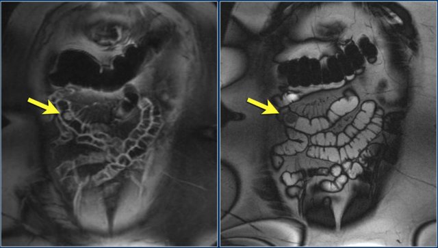 PA proven hemangioma: coronal T1 FS post contrast and coronal T2 show enhancing well defined intraluminal jejunal mass..