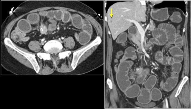Carcinoid with calcification and desmoplastic reaction. Obstructive small bowel ileus based on intraluminal component of carcinoid. Note small liver metastasis (arrow).