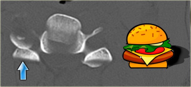 Inverted hamburger sign in unilateral interfacetal dislocation