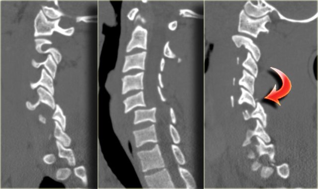 Cervical Spine Pathology, Radiology