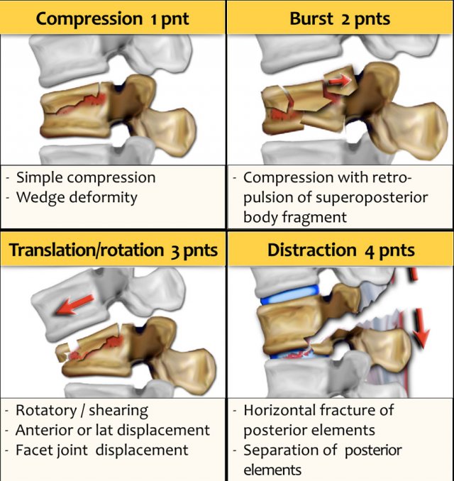 wedge in spine