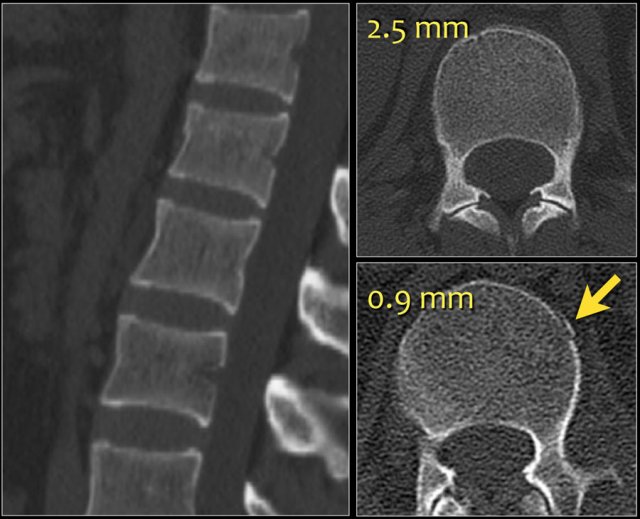 CT Scan of Lumbar Vertebral Column With L1 Vertebral Compression Fracture