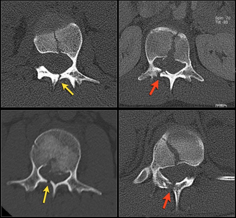 The Radiology Assistant : Spine fractures - TLICS Classification