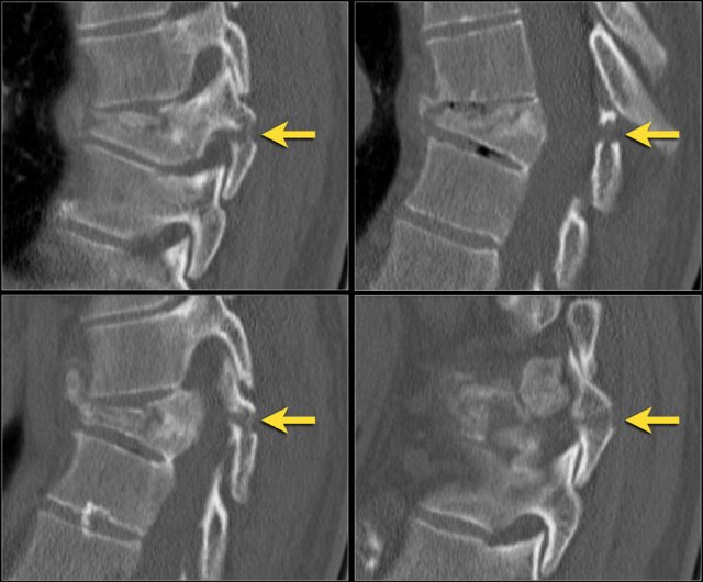 Trauma X-ray - Axial skeleton - Thoracolumbar spine - Normal anatomy
