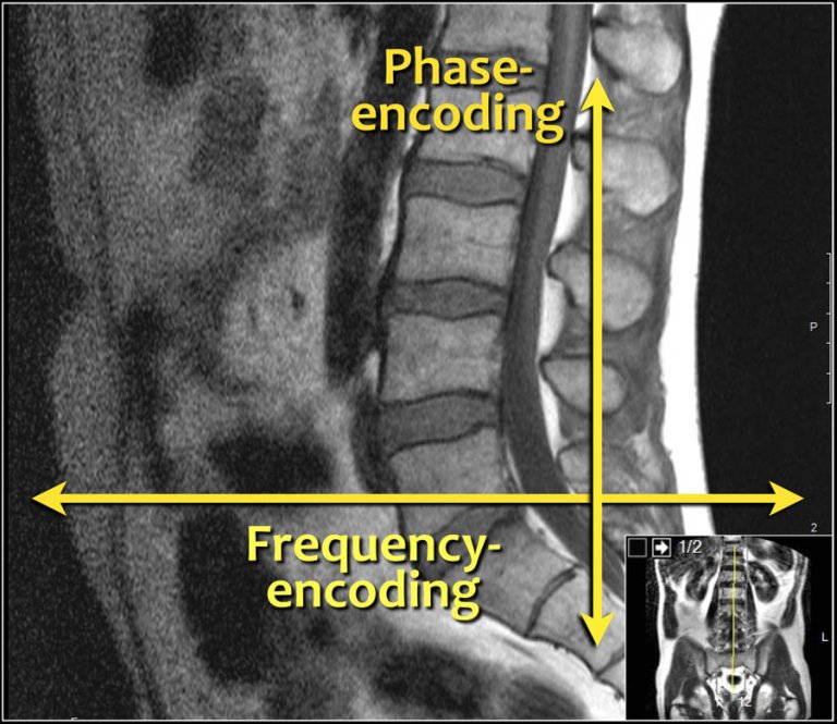 The Radiology Assistant : Lumbar Disc Herniation