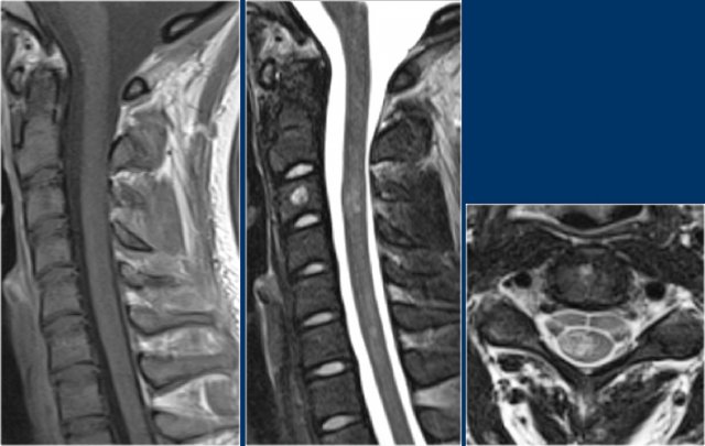 MS with non-specific findings in the spinal cord.