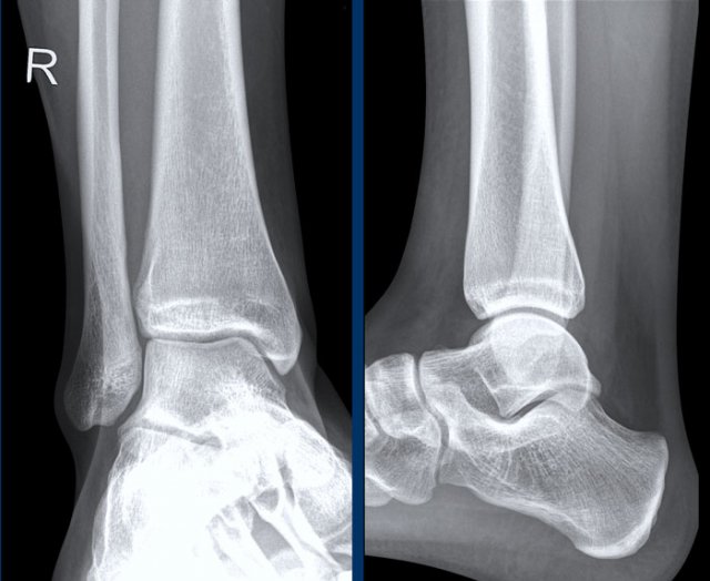 foot bone anatomy xray
