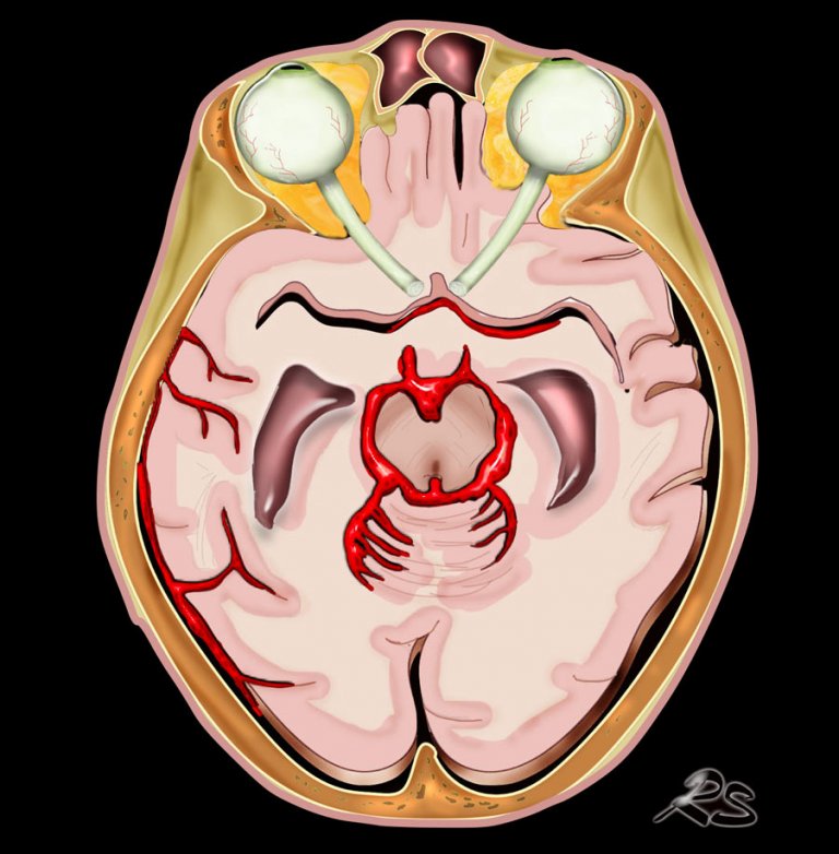 The Radiology Assistant : Non-traumatic Intracranial Hemorrhage