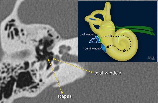 Radiopaedia - Drawing Middle ear ossicles: malleus, incus and