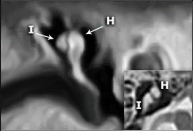 scutum temporal bone