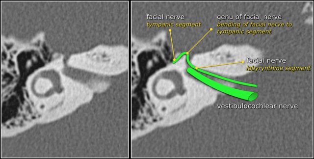 scutum temporal bone