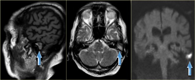 75-year old man with known recurrent cholesteatoma. The examination shows a mass with mixed intensity on sagittal T1 and high intensity on transverse T2 weighted images. It has a high intensity on diffusion weighted images, which indicates restricted diffusion. (arrows)