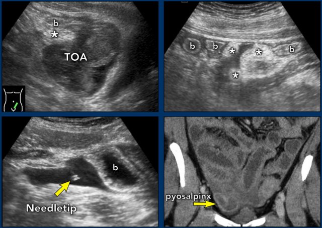 Bilateral tubo-ovarian abscesses with generalized peritonitis.