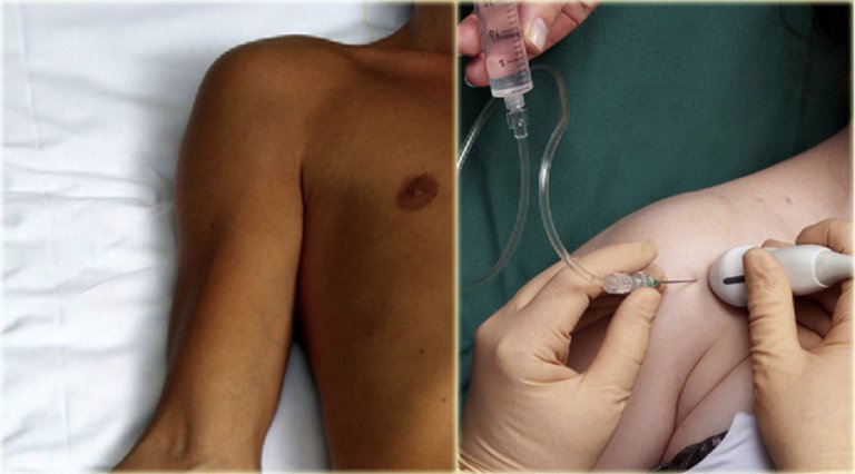 Corporal Injection The Radiology Assistant : US-guided injection of joints
