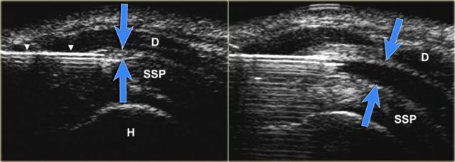 US-image showing a long axis view of the supraspinatus tendon (SSP). The advancing needle under real-time US-guidance has entered the subacromial bursa between the deltoid and SSP-muscle. Dilatation of the subacromial–subdeltoid bursa after injection of 5 mL fluid (blue arrows).