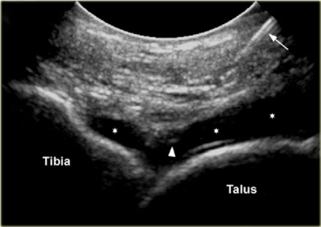 Sonogram showing the needle (arrow) and the needle tip (arrowhead) and the injected contrast media in the tibiotalar joint.