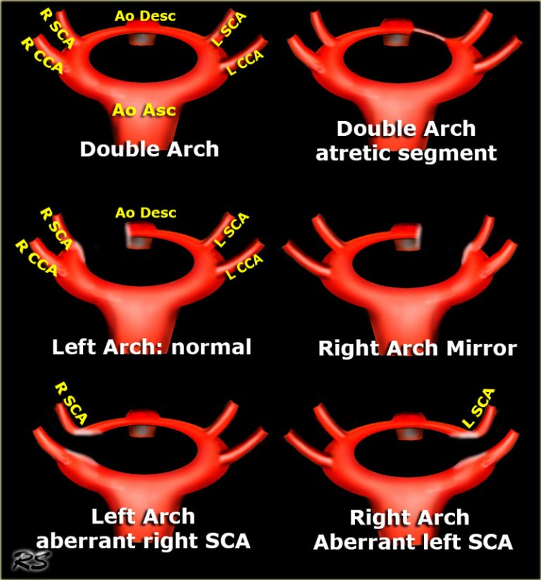 The Radiology Assistant : Vascular Anomalies of Aorta, Pulmonary and ...