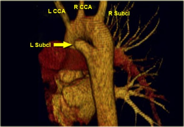 Posterior oblique view: Right Arch with Aberrant left subclavian (yellow arrow)
