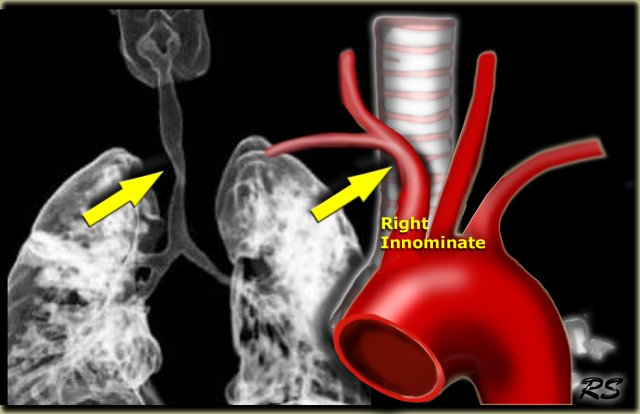 The Radiology Assistant : Vascular Anomalies of Aorta, Pulmonary and Systemic vessels