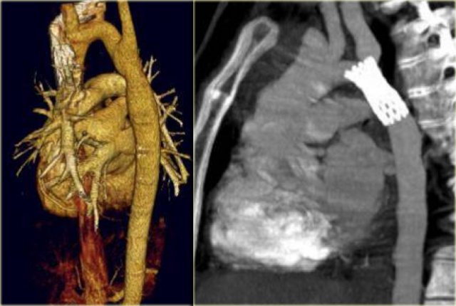 Coarctation treated with angioplasty (left) and stent placement (right)