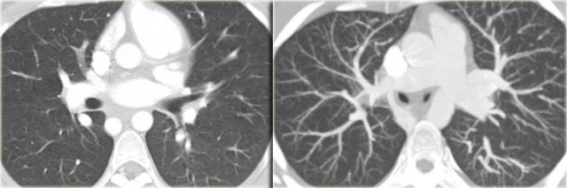 Thick slab maximal intensity projection to study the pulmonary vasculature.